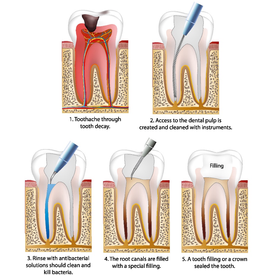 Endodonti (Kanal Tedavileri)